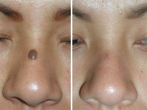 Mole Removal Toronto Safe Mole Removal Clinic In Toronto