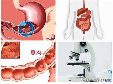 直腸癌多半是「拖」出來的！醫生提醒：身體有這4個症狀，早檢查 每日頭條