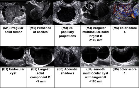 Methods Of Assessing Ovarian Masses Obstetrics And Gynecology Clinics