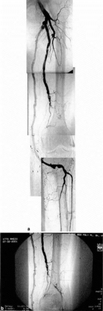 Enlargement Of Previously Ligated Popliteal Aneurysm Causing Venous