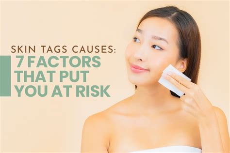 Skin Tags Causes: 7 Factors that Put You at Risk — Skin MD ...