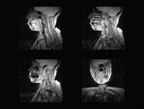 Anterior Cervical Corpectomy - Asian Spine Hospital