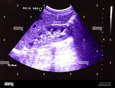 Kidney ultrasound scan Stock Photo - Alamy