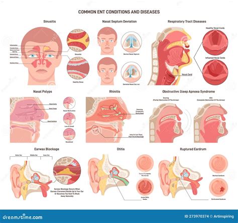 Common Ent Diseases Set Nose Throat And Ears Bacterial Infections Stock Illustration