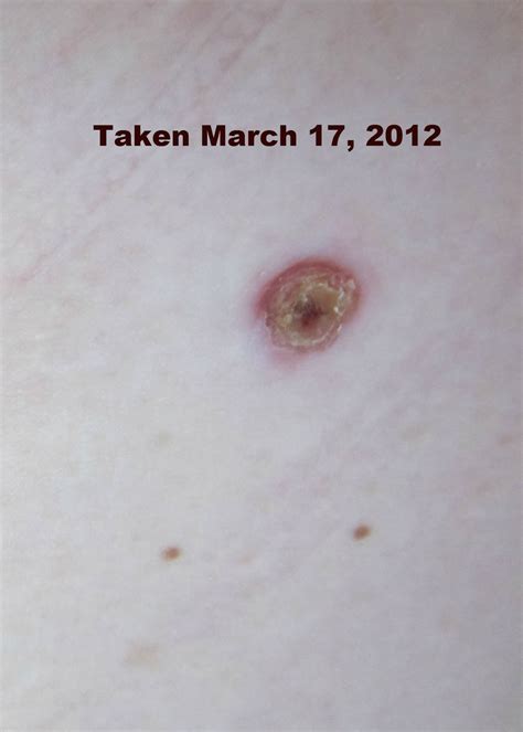 Melanoma: My Pain In the Bum!: April 2012