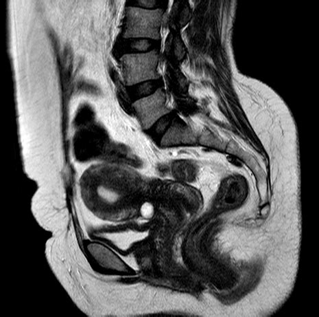 Cesarean Section Scar Diverticulum Image Radiopaedia Org