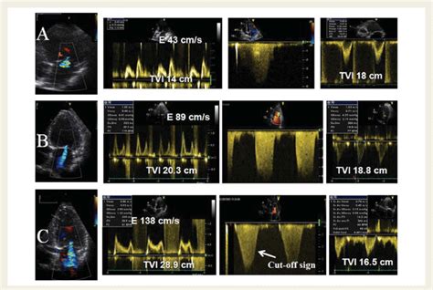 Mitral Regurgitation Quantification