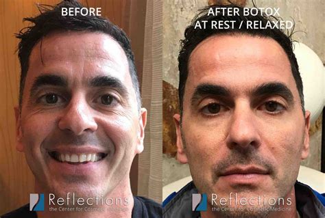 Proof Botox For Men Can Look Natural Before And After Photos New Jersey Reflections Center