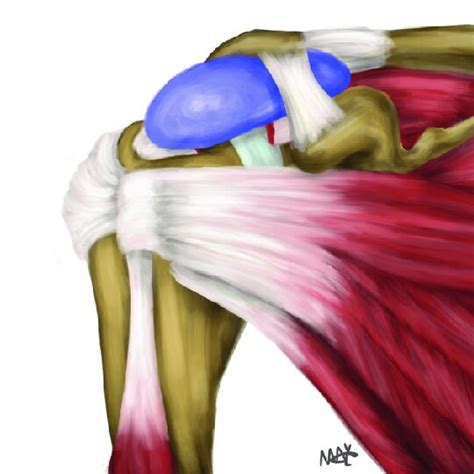 Schematic Diagram Of Inspace Balloon Inserted In The Subacromial Space