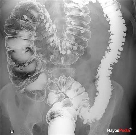 Left Side Colonic Diverticulosis Rfoamed911