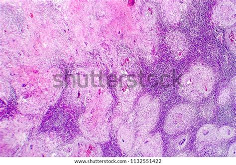 Caseous Necrosis Lymphatic Node Light Micrograph Stock Photo 1132551422