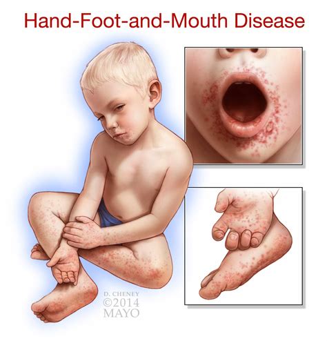 Hand, Foot And Mouth Disease On The Rise Parents Cautioned | Government