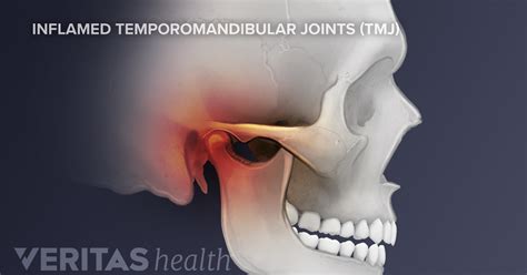 Symptoms Of Temporomandibular Joint Tmj Disorders