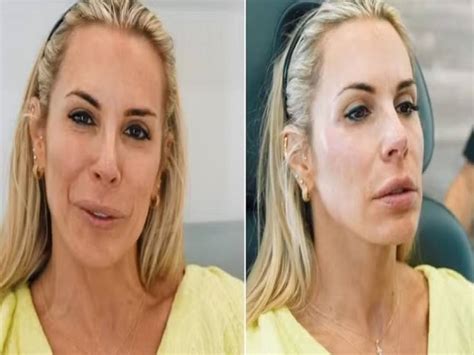 Ex Feiticeira Joana Prado faz harmonização facial e celebra resultado