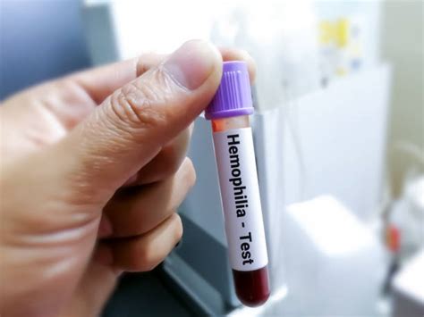 Hemoglobin Test: What It Is, Procedure & Results