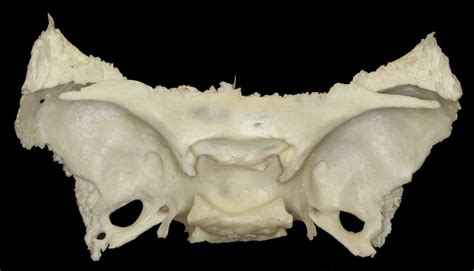 Superior Perspective Of Sphenoid Bone Neuroanatomy The