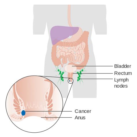 Anal Cancer Wikipedia