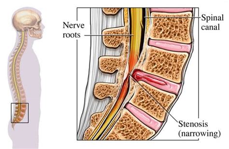 Spinal Stenosis Treatment Back Pain Relief Murray Ut