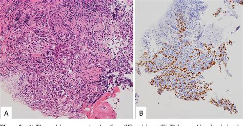 Figure 1 From A Case Of Basaloid Squamous Cell Carcinoma Of The Lung