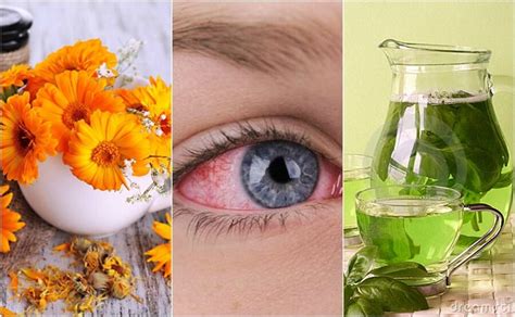 Los Mejores Remedios Para Calmar La Conjuntivitis Naturalmente