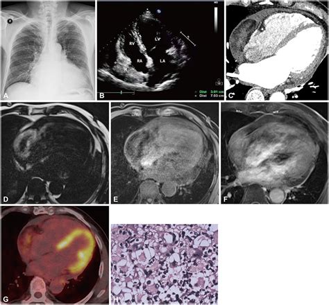 Primary Pericardial Liposarcoma The Role Of Multi Modality Imaging In