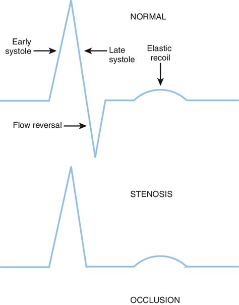 (Top) Normal triphasic arterial wave pattern is | Download Scientific ...