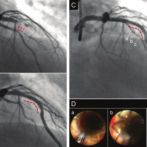 A Representative Case Of Ami With Platinum Chromium Everolimus Eluting