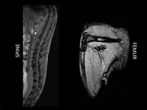 Multiple myeloma, MRI | Lurie Family Imaging Center