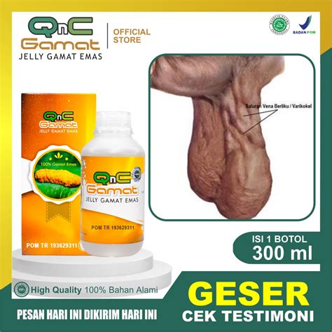 Jual Obat Varikokel Pembengkakan Skrotum Testis Bengkak Sebelah Nyeri