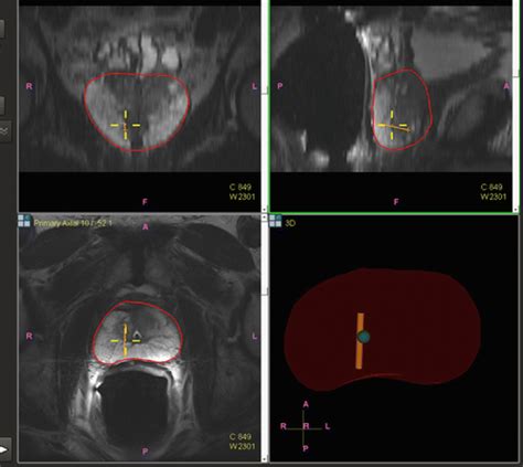 Prostate Mri Fusion Biopsy Procedure