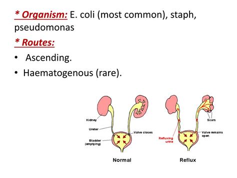 Ppt Interstitial Cystitis Powerpoint Presentation Free Download Id 1917026