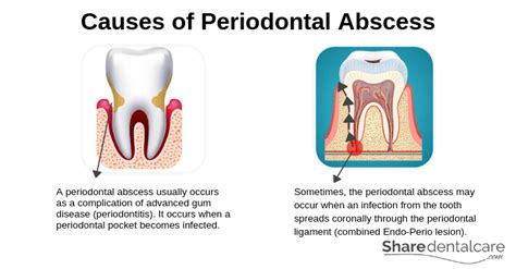 Periodontal Abscess Symptoms Causes And Treatment Share Dental Care