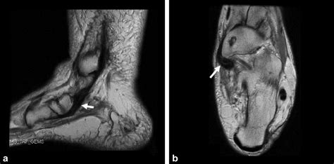 Postoperative Magnetic Resonance Imaging Of The Foot And Ankle Sofka