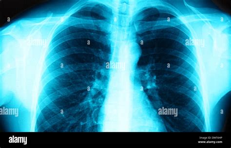 Thorax x ray Stock Photo - Alamy