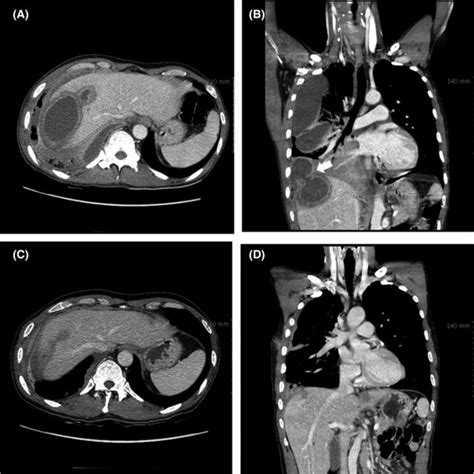 A A Contrast‐enhanced Computed Tomography Scan Ct Of The Chest