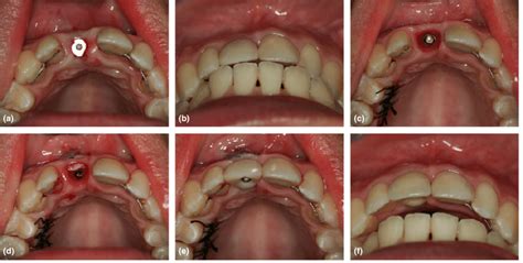 Occlusal view of a NobelActiveÒ implant (Nobel Biocare, Gothenburg ...