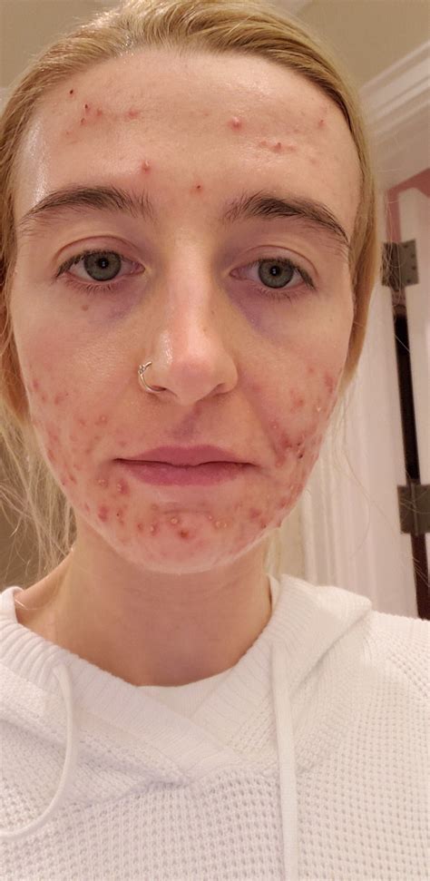 Back Acne Before And After Accutane
