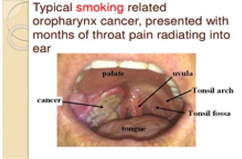 Oropharyngeal Cancer