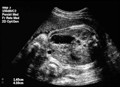 Prenatal Sonographic Detection Of Meckel Diverticulum In Utero With