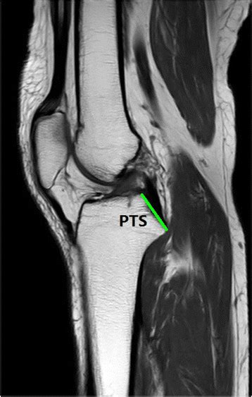 PTS Posterior Tibial Shelf The Slope Where The PCL Tibial