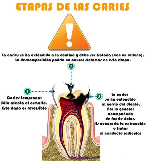 Etapas De La Caries Infografia Clinica Dental Bonadent