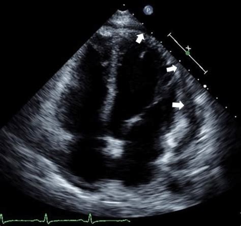 Transthoracic Echocardiography Apical 4 Chamber View Showing Mild