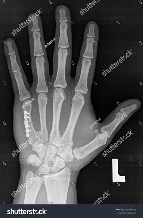 Metacarpal X Ray