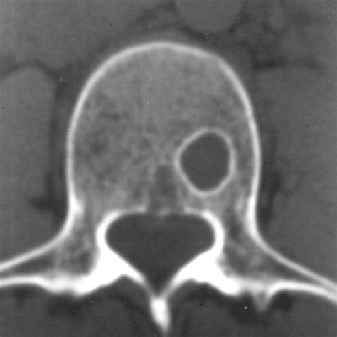 Giant Cystic Schmorl S Nodes Imaging Findings In Six Patients Ajr