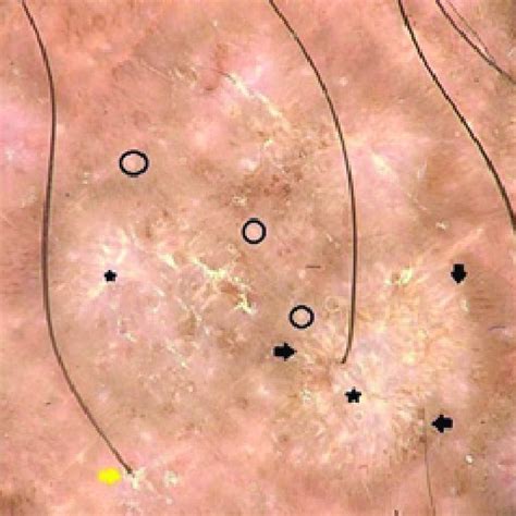 Sex Distribution Of Patients With Primary Localized Cutaneous