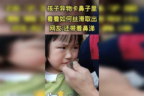 当孩子异物卡鼻子里，看看如何丝滑取出鼻子异物孩子