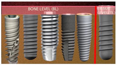 Soft Tissue Implant Integration Part 2