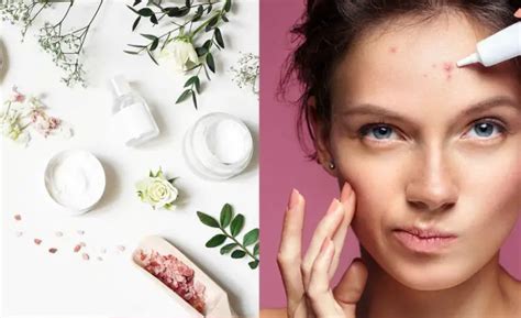 Diy Acne Spot Treatments Natural Solutions For Clearer Skin Beauty