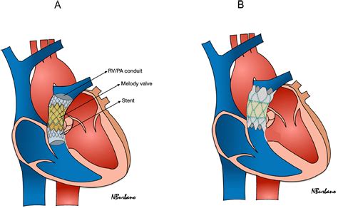 The Role Of Novel Transcatheter Procedures In Patients With Congenital