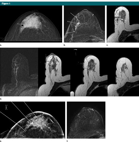 Figure 1 From Impact Of Preoperative Breast MR Imaging And MR Guided